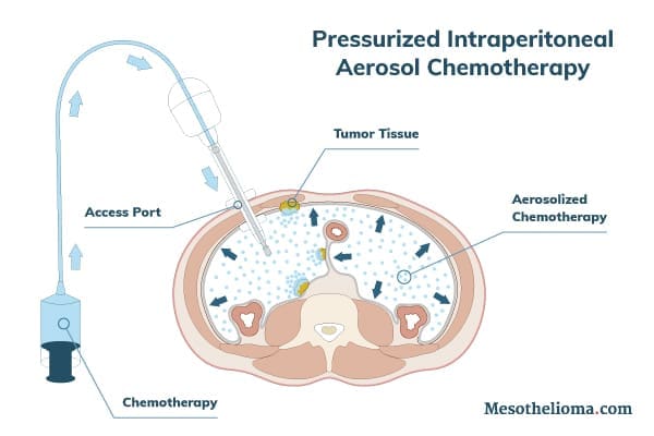 A diagram showing the procedure for PIPAC treatment for mesothelioma