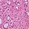Rare mesothelioma cells under a microscope
