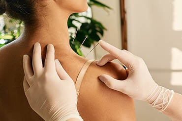 Image of a woman receiving acupuncture needles to the shoulder