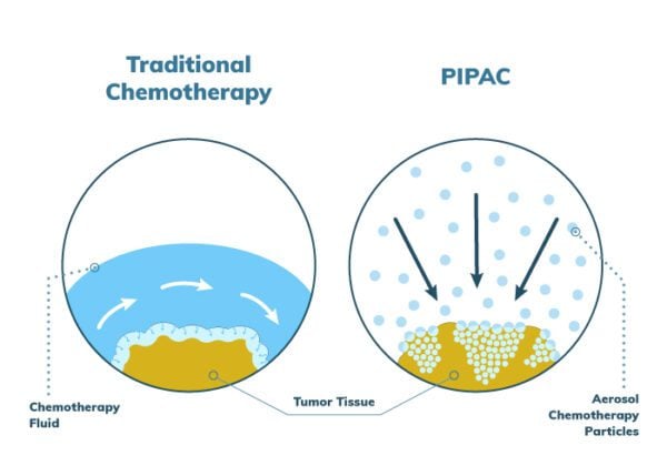 Illustration of fluid vs. aerosolized chemotherapy