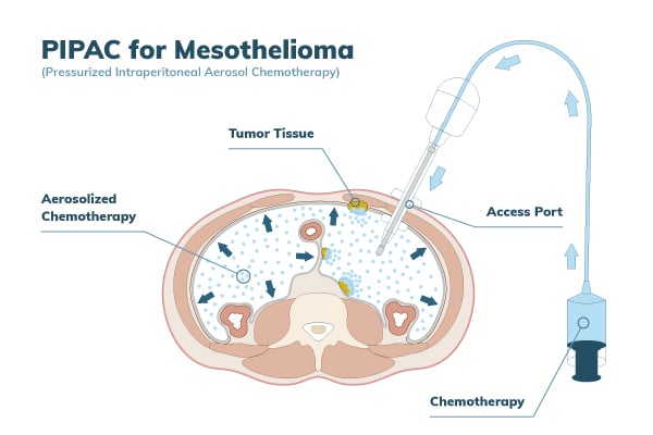 PIPAC treatment for mesothelioma