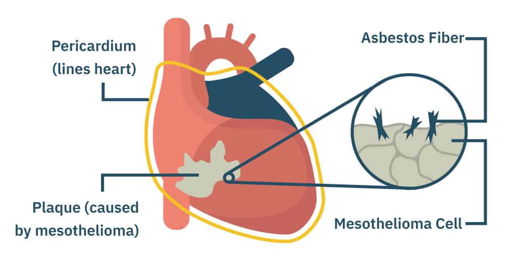 why does mesothelioma kill you