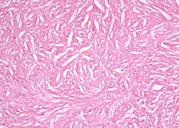 Desmoplastic mesothelioma cells under microscope