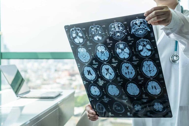 Does Mesothelioma Spread to the Brain? | Mesothelioma.com